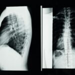 x ray images of the spine
