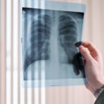 doctor looking at lung x ray